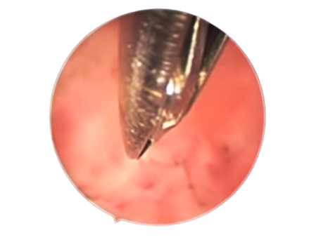 Hysteroscopy Guided Endo Biopsy