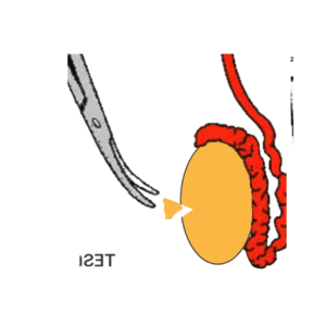 Vasectomy-Reversal-Vs-IVF