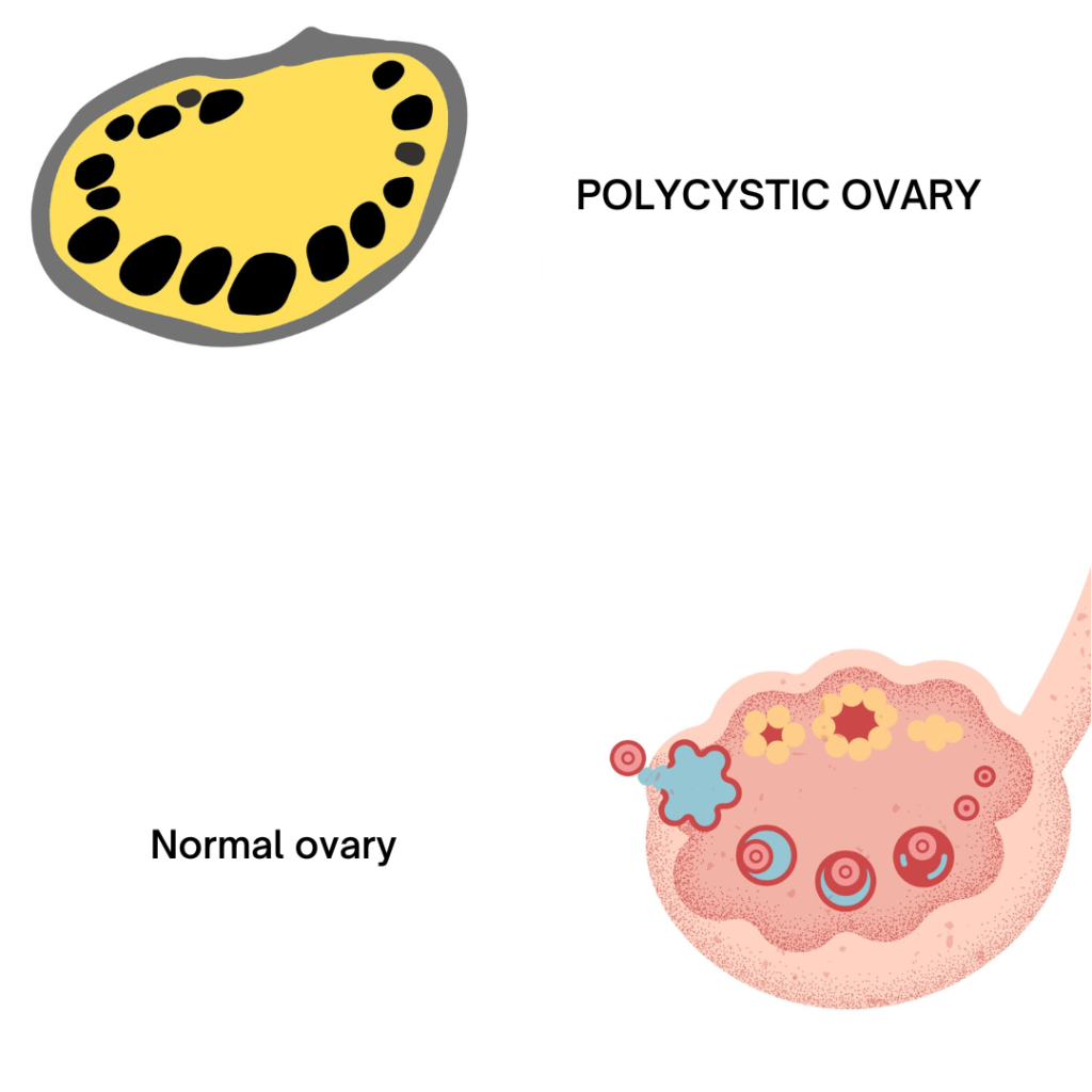 What-is-PCOS