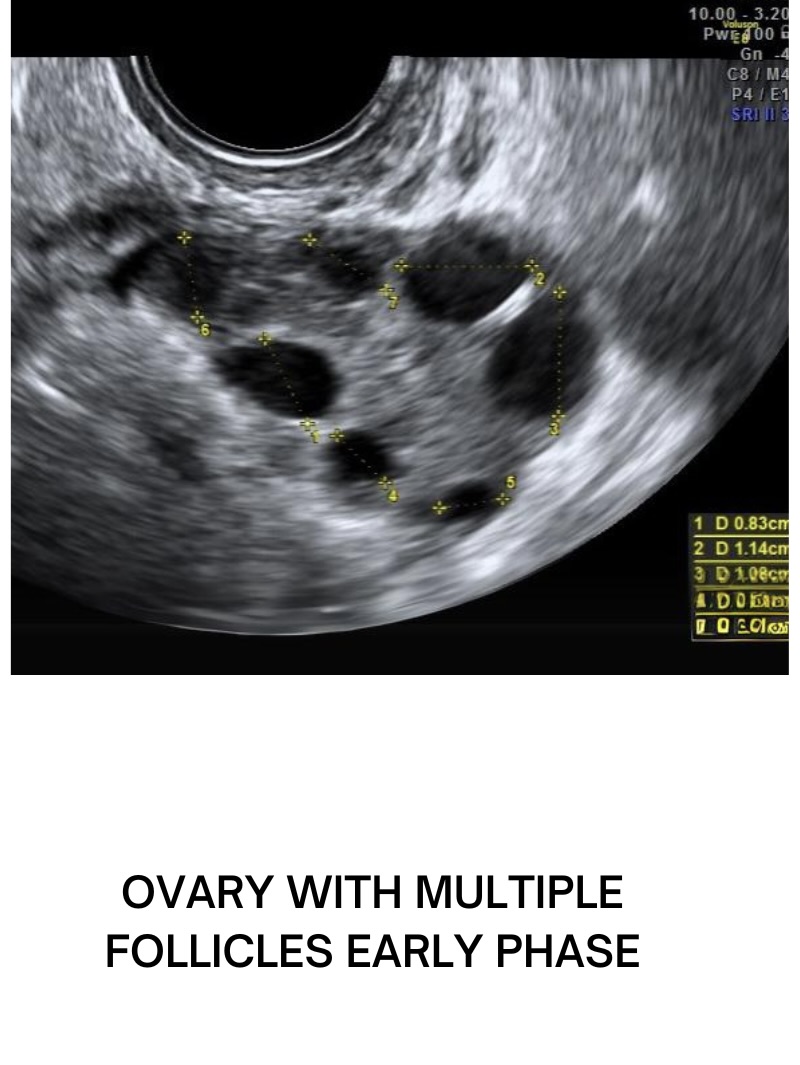 Ovarian Follicle Ultrasound Investigation Of Ovarian Follicular Waves