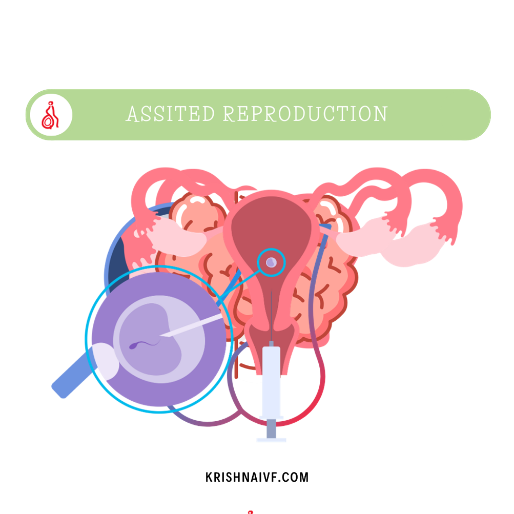 Assisted-Reproduction