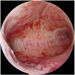 Minimally-Invasive-Solution-for-Womens-Health-and-Fertility5