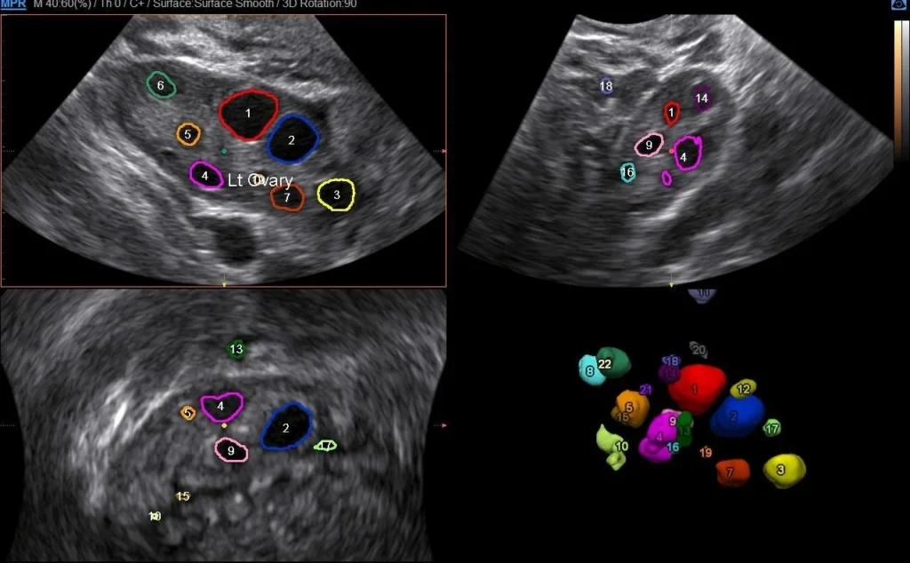 5D follicular imaging ultrasound