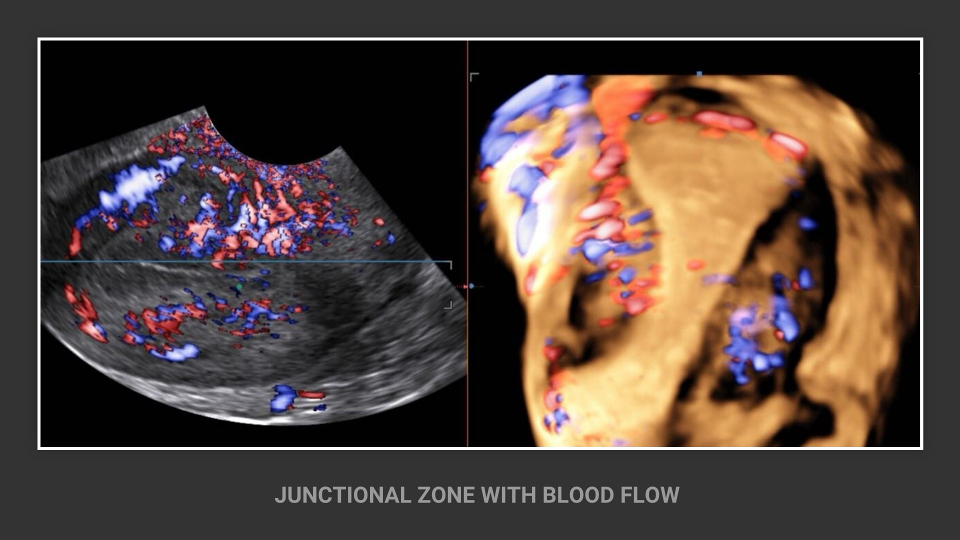 Junctional Zone Blood Flow