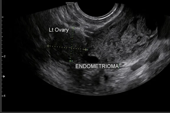 endometriosis anatomical illustration
