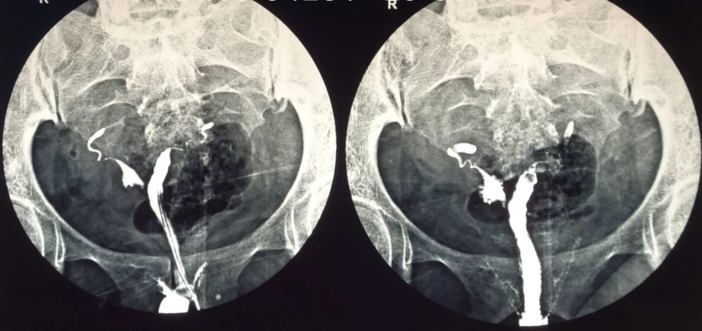 hysterosalpingography procedure illustration
