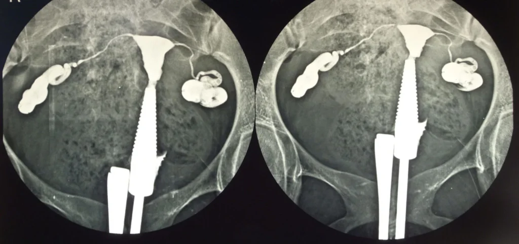 hysterosalpingography procedure illustration