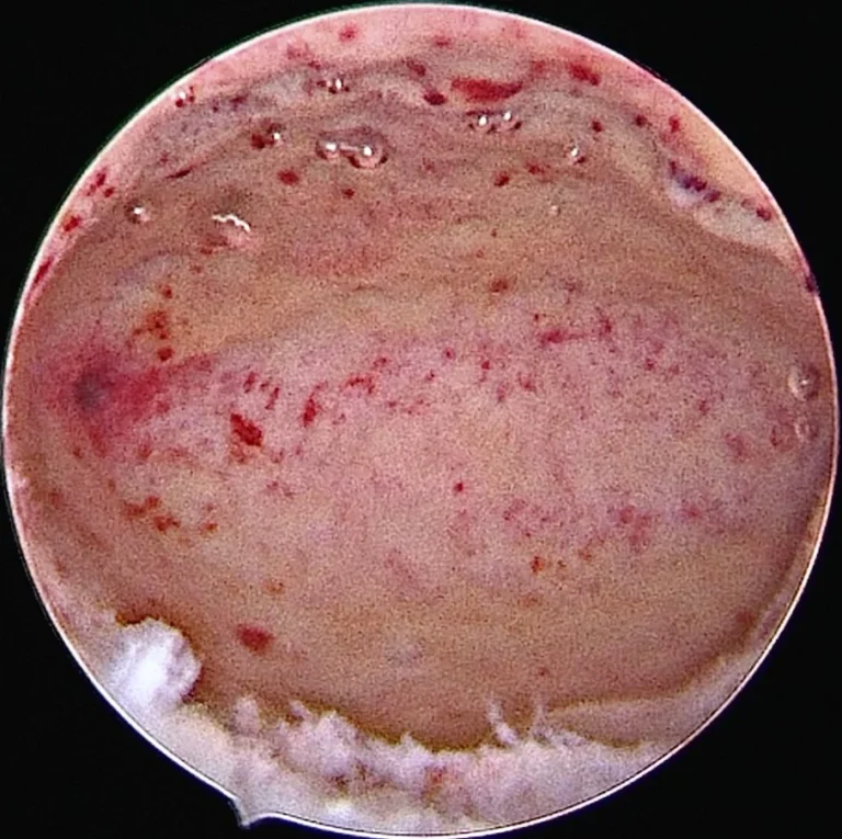 hysteroscopic uterine cavity assessment