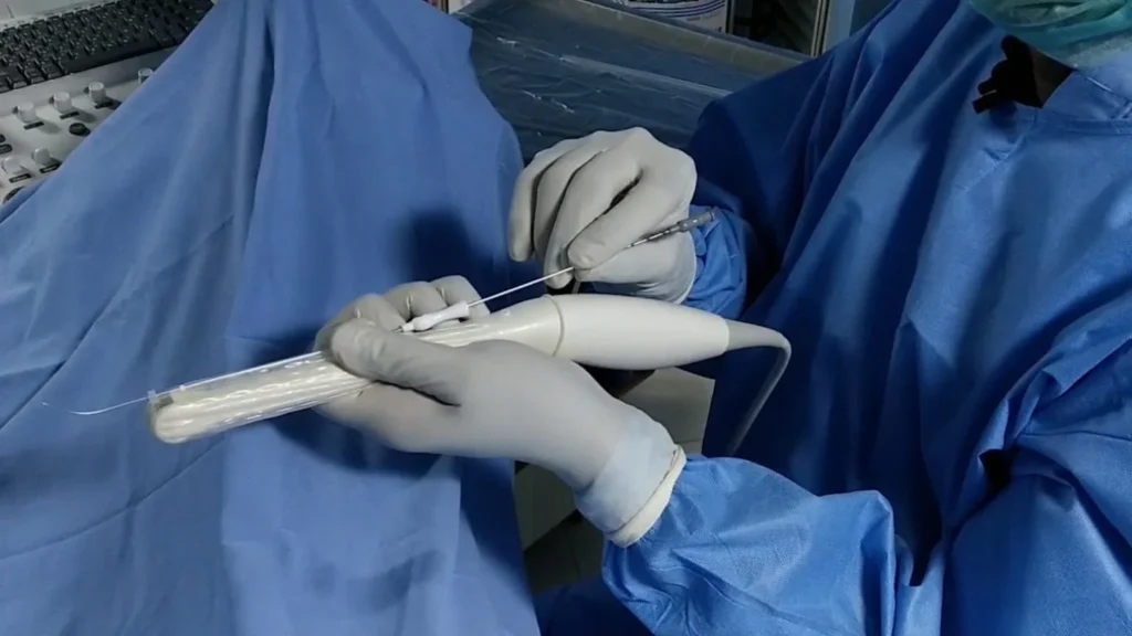 ultrasound guided embryo transfer