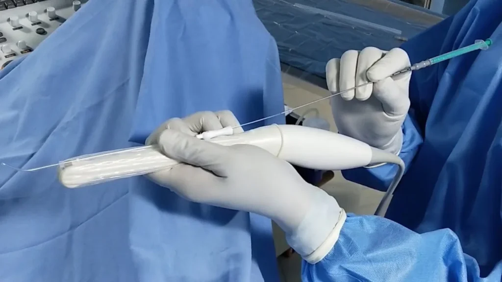 ultrasound guided embryo transfer