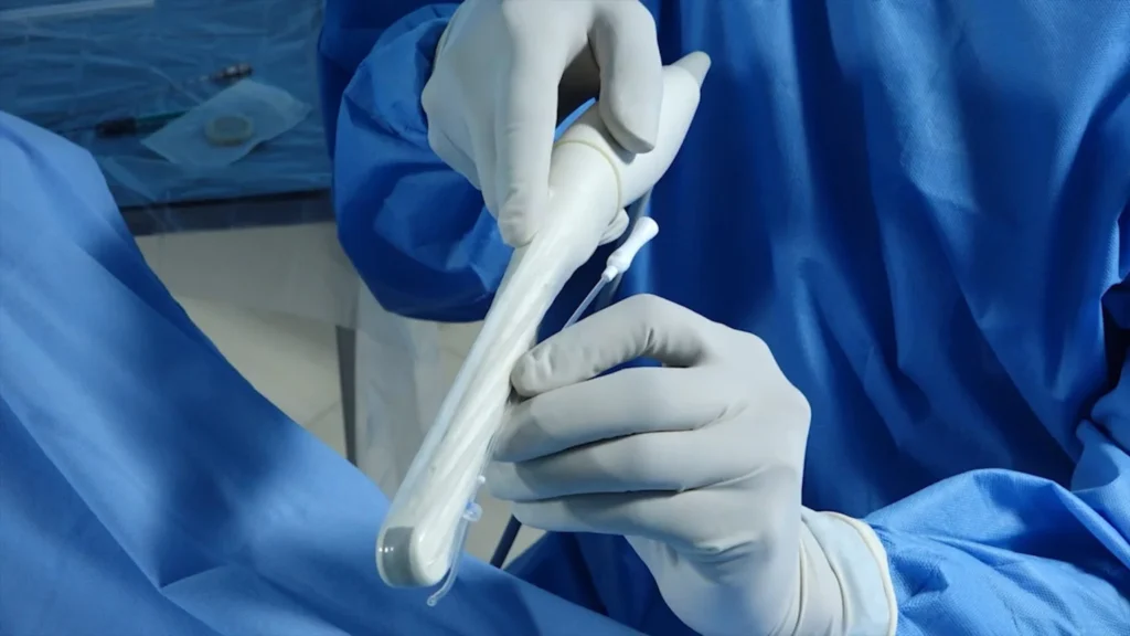 ultrasound guided embryo transfer