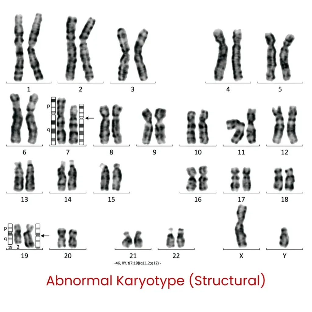 abnormal karyotype structural