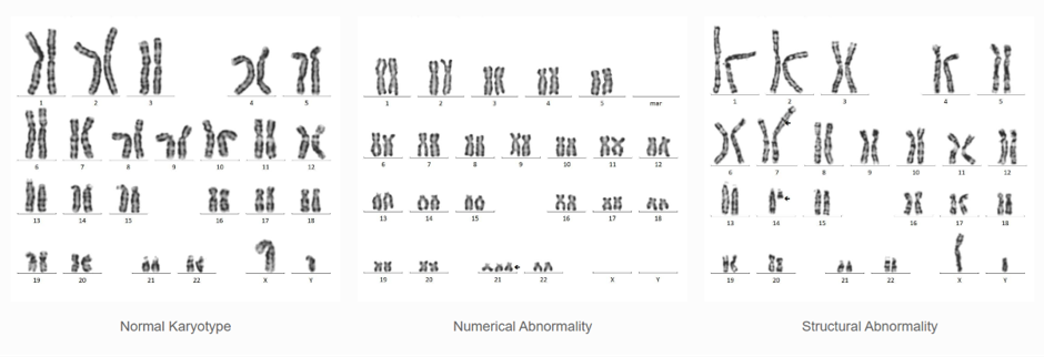 Comparison of normal karyotype, numerical chromosome abnormality and structural chromosome abnormality